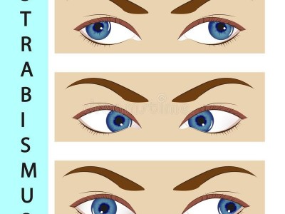STRABISMUS EYE SURGERY
