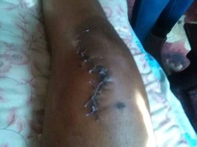 fund for Surgical expense