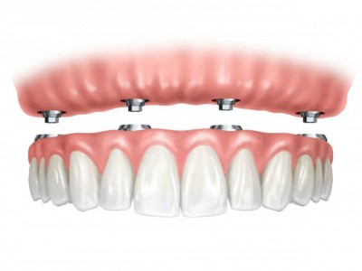 Help to get a fixed dental plate