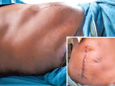 Daniel to get Intestinal obstruction surgery