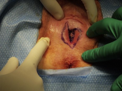 Vulvodynia surgery