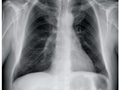 Help with respiratory desease treatment