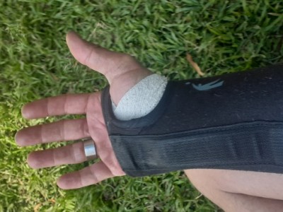 Carpal Tunnel surgery