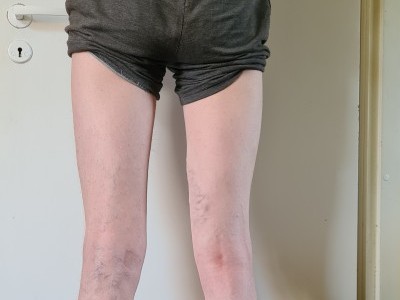 Help Aivis walk normal again!