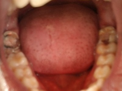 Fix teeth