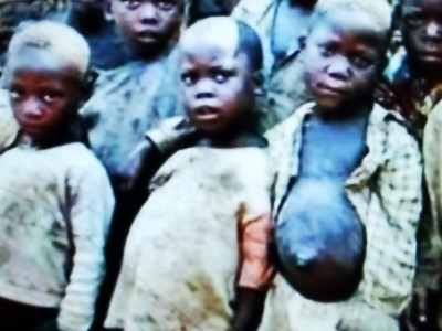 Kids poor and sick of malaria in Tanzania