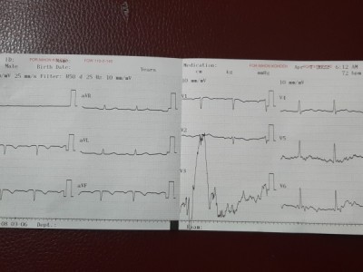 Heart Surgery