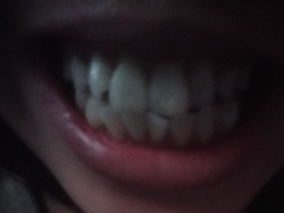 For fixing my teeth