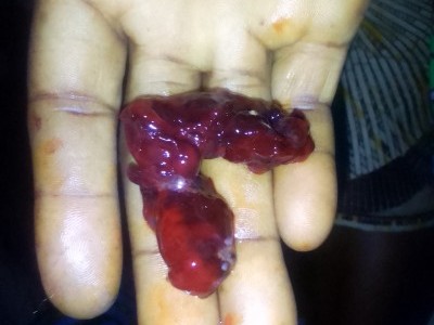 Nasopharyngeal cancer