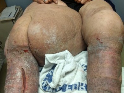 Critical, need tumors removed