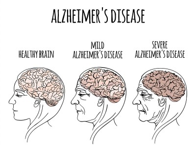 Need help caring for my mother with Alzheimer's