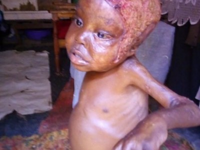Support Aisha to Undergo Medical Surgery