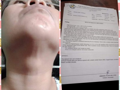 Operation for my mother with thyroid cysts