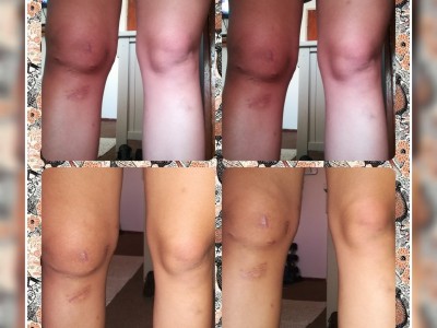 Urgent knee surgery