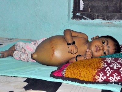 She Will Die Because Of Liver Disease; Help!