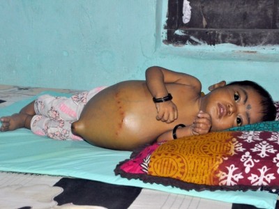 She Will Die Because Of Liver Disease; Help!