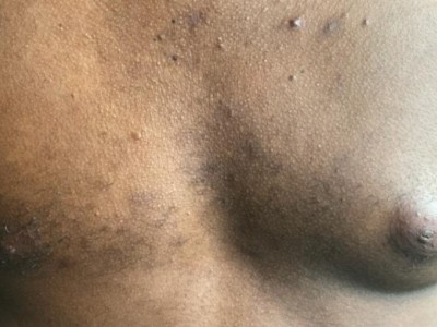 Gynecomastia Treatment