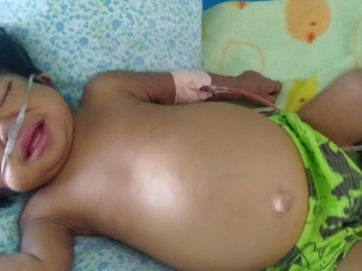 Liver Transplant