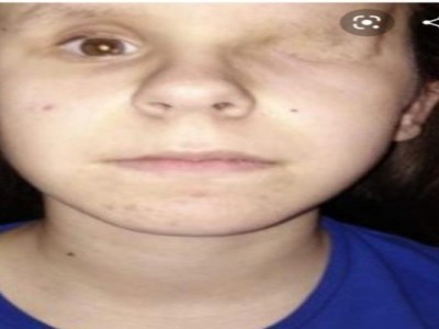 Eye cancer therapy