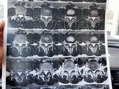 Spine surgery