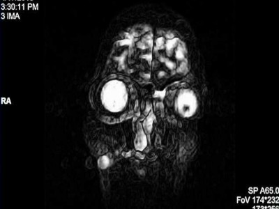 SINUSITIS ODONTOGENIC MAXILARY SURGERY