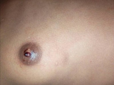 Breast cancer