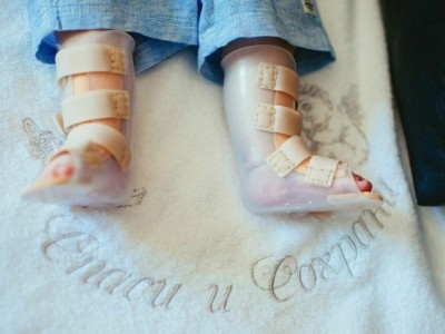 My baby leg oparetion