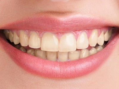 Help me to fix my teeth