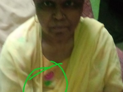 Need help for breast cancer