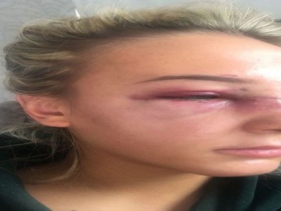 nose surgery