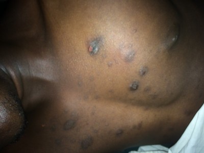 Some chronic disease