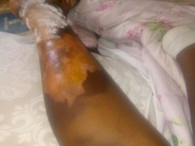 Need help burnt by hot water